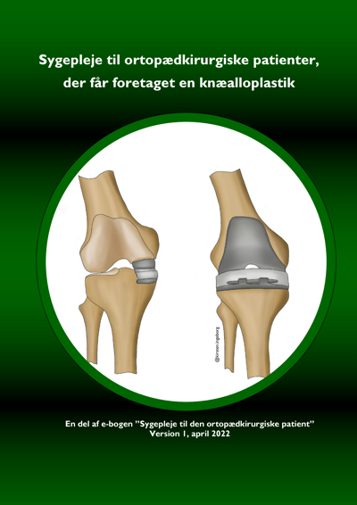 Knæalloplastik – Forside