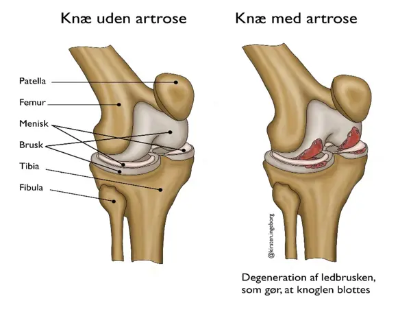 Knæ Uden Og Med Artrose.