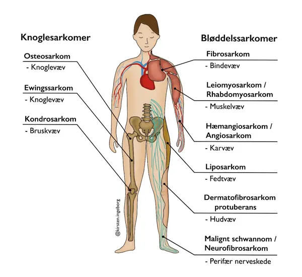 Illustration Af Forskellige Typer Af Knogle Og Bløddelssarkomer